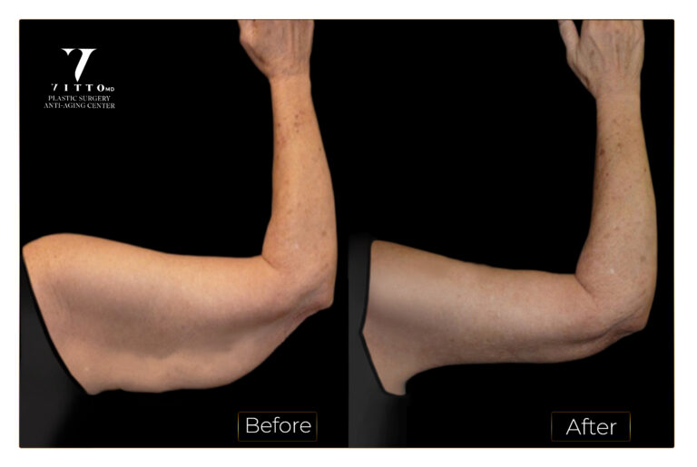BeforeAfter14-2-armL-web