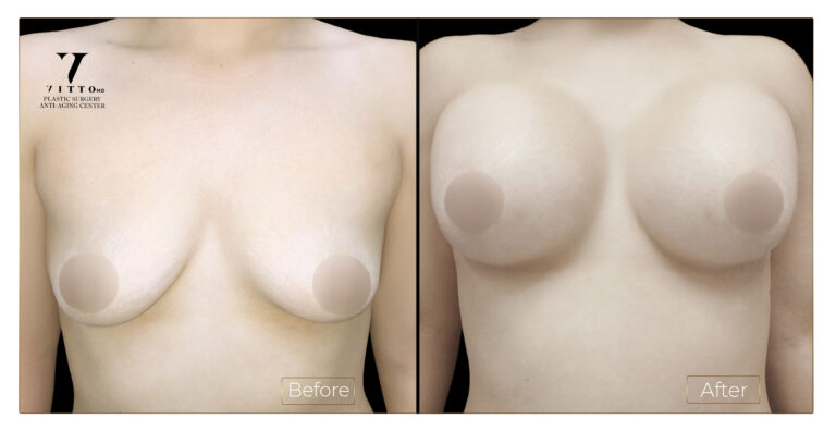 Breast-Aug2-c5-duplicar-large