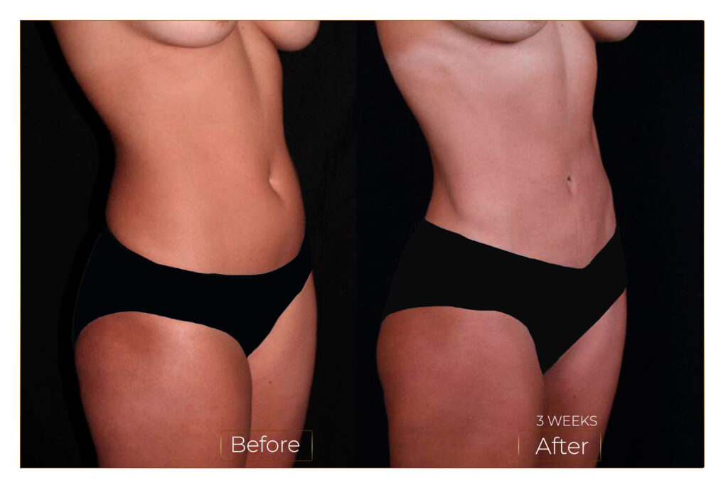 Lipo 360 - VITTO MD PLASTIC SURGERY AND ANTIAGING CENTER